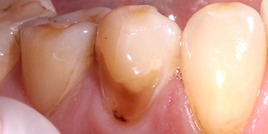 Лечение кариеса корня зуба 'до' в клинике Super Smile кейс 2