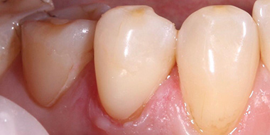 Лечение кариеса корня зуба 'после' в клинике Super Smile кейс 2