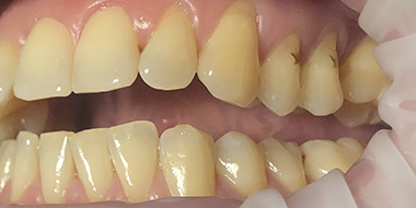 Лечение дефекта зуба 'до' в клинике Super Smile кейс 3