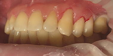 Лечение шейки зуба 'после' в клинике Super Smile кейс 3