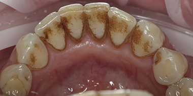 Лечение кариеса передних зубов 'до' в клинике Super Smile кейс 1