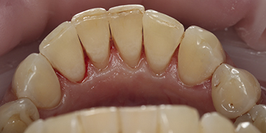 Лечение кариеса корня зуба 'после' в клинике Super Smile кейс 1