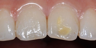 Лечение кариеса передних зубов 'до' в клинике Super Smile кейс 2