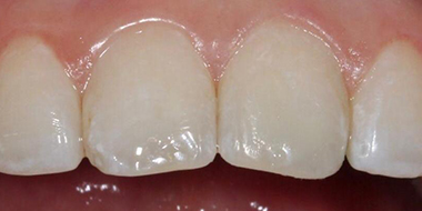 Лечение некариозных поражений тканей зуба 'после' в клинике Super Smile кейс 2
