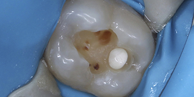 Лечение кариеса передних зубов 'до' в клинике Super Smile кейс 3