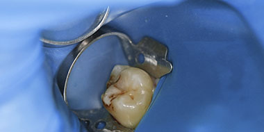 Лечение резорбции зуба 'до' в клинике Super Smile кейс 1