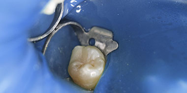 Лечение гранулемы зуба 'после' в клинике Super Smile кейс 1