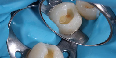 Лечение между зубами 'до' в клинике Super Smile кейс 3