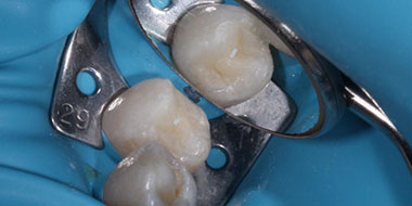 Лечение сломанного зуба 'после' в клинике Super Smile кейс 3