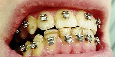 Лечение пародонтитa зуба 'до' в клинике Super Smile кейс 3