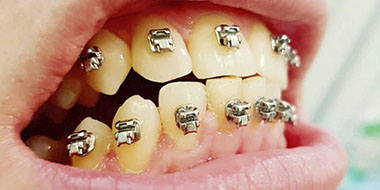 Лечение пародонтитa зуба 'после' в клинике Super Smile кейс 3