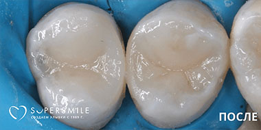Лечение между зубами 'после' в клинике Super Smile кейс 2