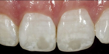 Лечение зубов фтором 'до' в клинике Super Smile кейс 1