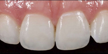 Лечение некариозных поражений тканей зуба 'после' в клинике Super Smile кейс 1
