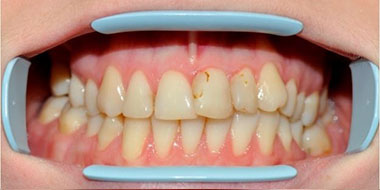 Лечение некариозных поражений тканей зуба 'до' в клинике Super Smile кейс 3