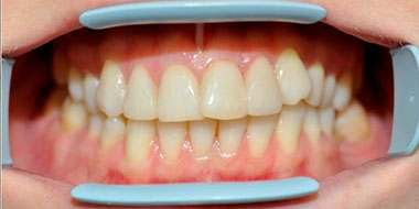 Лечение зубов фтором 'после' в клинике Super Smile кейс 3