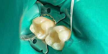 Лечение резорбции зуба 'до' в клинике Super Smile кейс 3