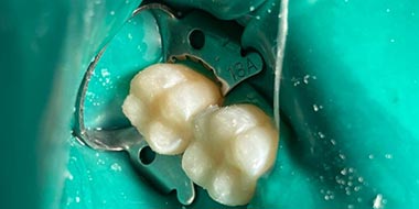 Лечение гнилых зубов 'после' в клинике Super Smile кейс 3
