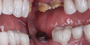 Протезирование частичной потери зубов 'до' в клинике Super Smile кейс 1