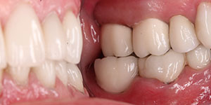 Протезирование частичной потери зубов 'после' в клинике Super Smile кейс 1