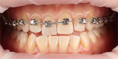 Восстановление неправильного положения зубов 'до' в клинике Super Smile кейс 2