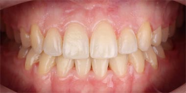 Восстановление неправильного положения зубов 'после' в клинике Super Smile кейс 2
