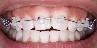 Исправление скученности зубов и неправильного прикуса 'до' в клинике Super Smile кейс 3