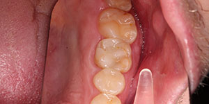 Протезирование зубов коронками из металлокерамики 'до' в клинике Super Smile кейс 1