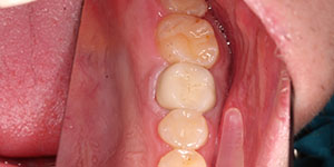 Протезирование зубов коронками из металлокерамики 'после' в клинике Super Smile кейс 1