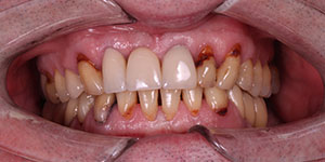 Протезирование зубов коронками 'до' в клинике Super Smile кейс 2
