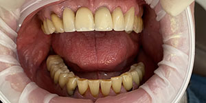 Протезирование зубов коронками 'после' в клинике Super Smile кейс 2