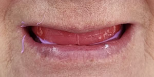 Установка нейлоновых зубных протезов 'до' в клинике Super Smile кейс 1