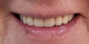 Установка зубных протезов на присосках 'после' в клинике Super Smile кейс 1