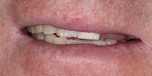 Установка зубных протезов на крючках 'до' в клинике Super Smile кейс 3