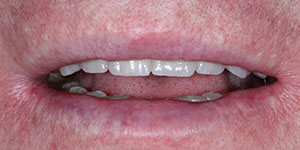 Установка акриловых зубных протезов 'после' в клинике Super Smile кейс 3