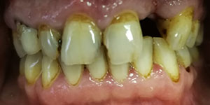 Адгезивное протезирование зубов 'до' в клинике Super Smile кейс 1