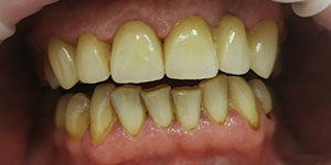 Установка телескопических зубных протезов 'после' в клинике Super Smile кейс 1