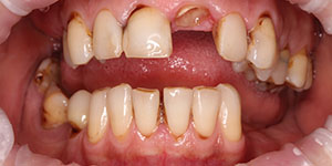 Адгезивное протезирование зубов 'до' в клинике Super Smile кейс 3