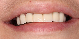 Адгезивное протезирование зубов 'после' в клинике Super Smile кейс 3