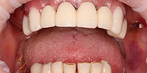 Протезирование зубов верхней челюсти 'после' в клинике Super Smile кейс 1