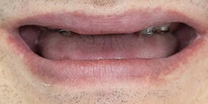 Протезирование зубов верхней челюсти 'до' в клинике Super Smile кейс 2