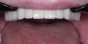 Протезирование зубов верхней челюсти 'после' в клинике Super Smile кейс 2