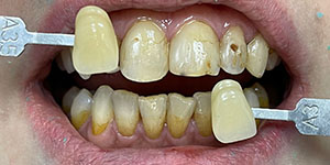 Протезирование зубов верхней челюсти 'до' в клинике Super Smile кейс 3