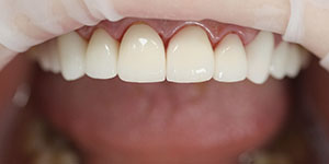 Протезирование зубов верхней челюсти 'после' в клинике Super Smile кейс 3