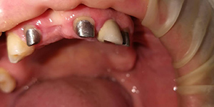 Установка пластинчатых зубных протезов 'до' в клинике Super Smile кейс 1