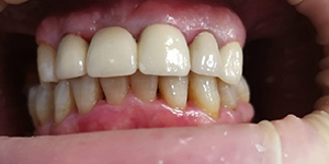 Установка пластинчатых зубных протезов 'после' в клинике Super Smile кейс 1