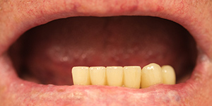Протезирование зубов Акри Фри 'до' в клинике Super Smile кейс 2