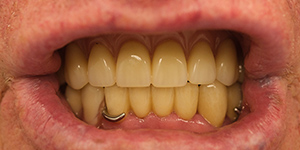 Установка пластинчатых зубных протезов 'после' в клинике Super Smile кейс 2