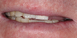 Протезирование зубов Акри Фри 'до' в клинике Super Smile кейс 3