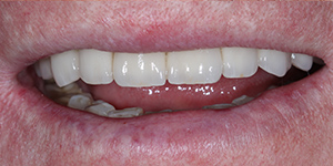 Протезирование зубов Акри Фри 'после' в клинике Super Smile кейс 3